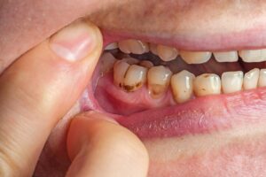 Caries Dental: Causas, Prevención y Tratamiento