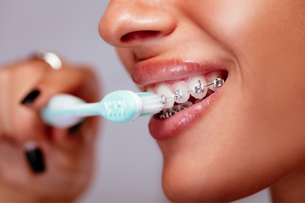 Cómo Limpiar tus Brackets Correctamente: Guía Completa para una Ortodoncia Saludable